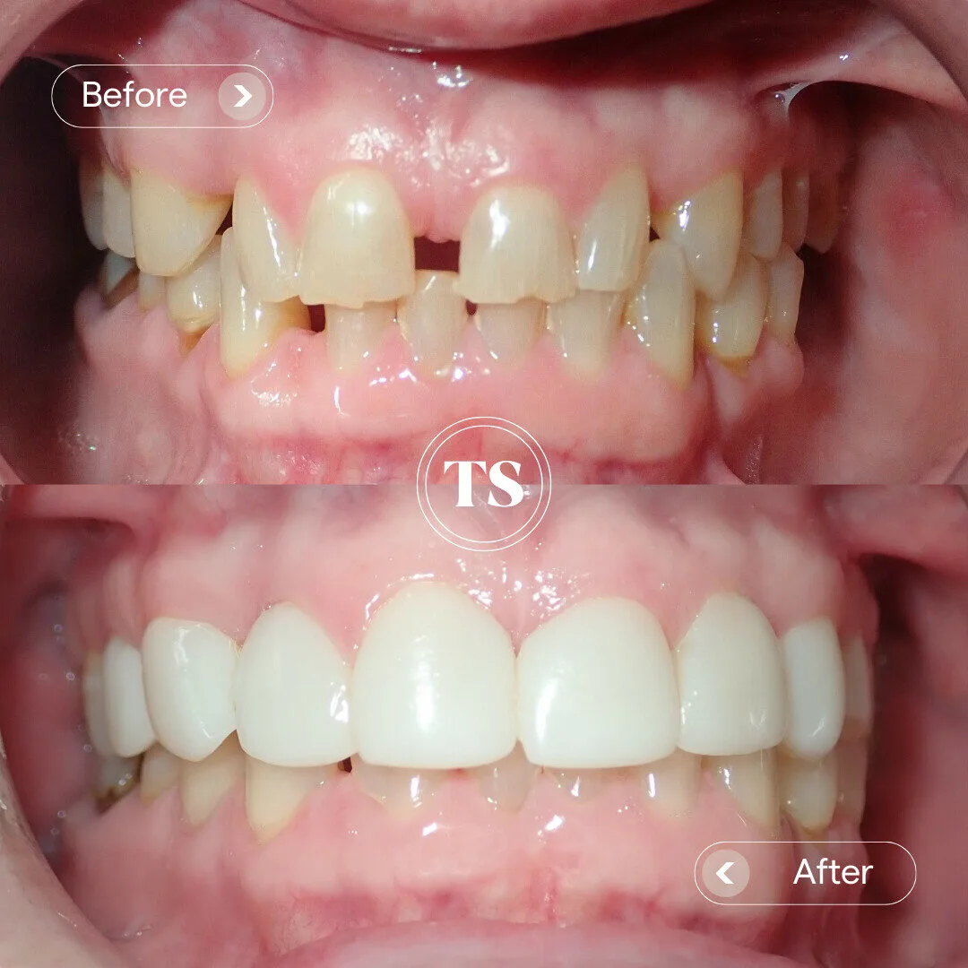 Grace’s Composite Veneers Makeover