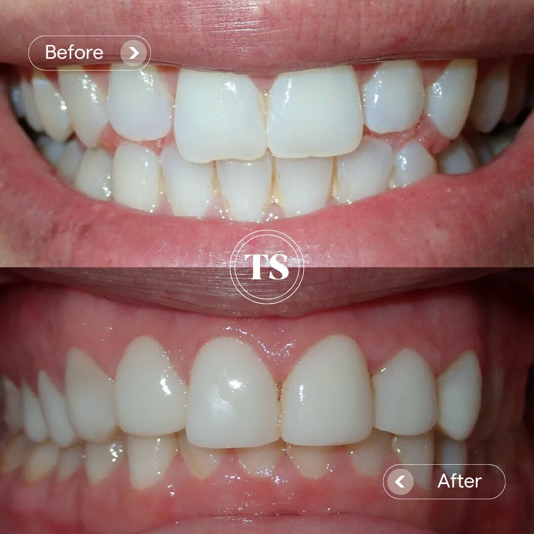 Harper’s Composite Veneers Makeover