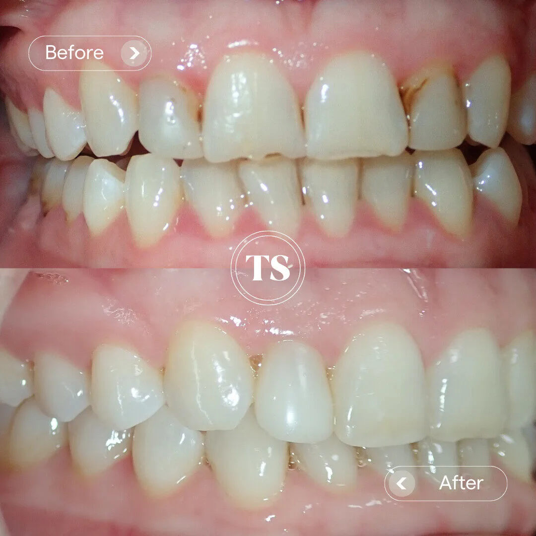Isla’s Composite Veneers Makeover