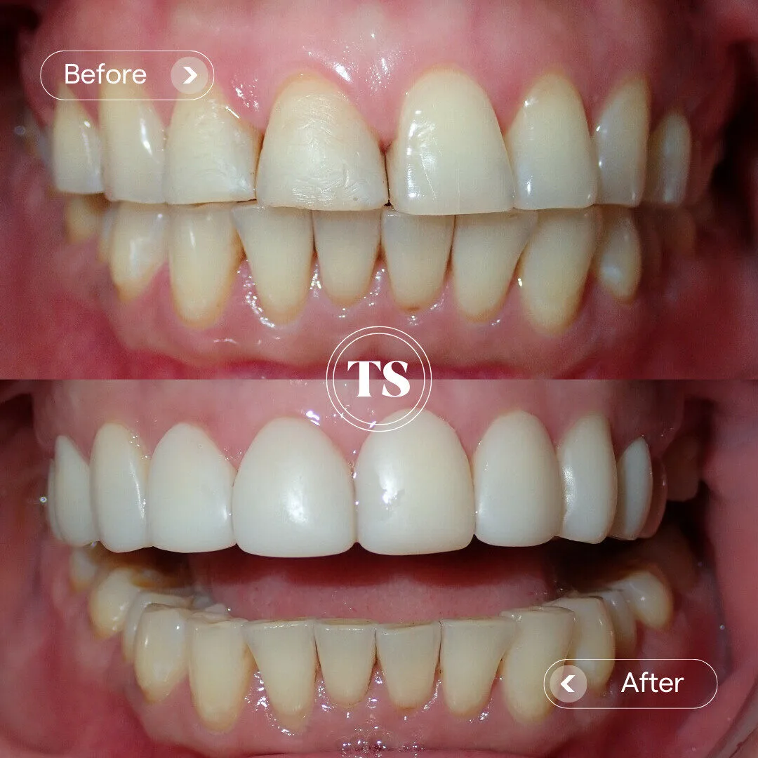 Jasmine’s Composite Veneers Makeover