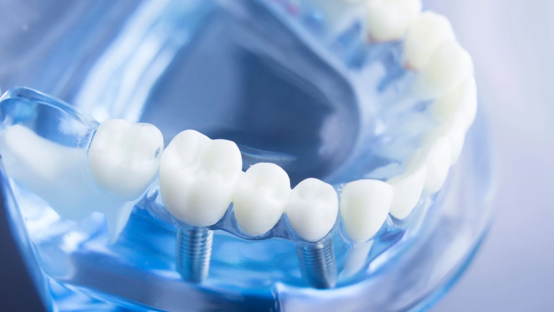 Dental Implant and Crowns in Narellan in ToothSavers™