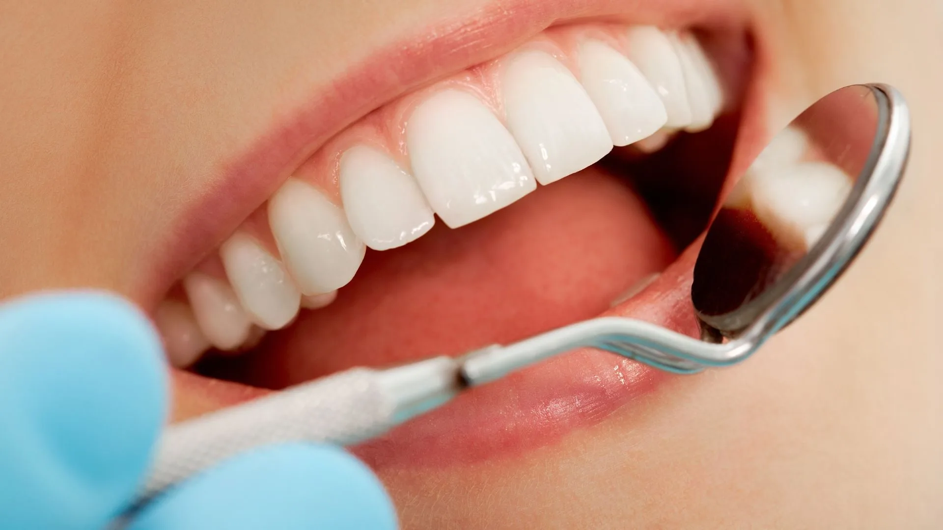 Full mouth reconstruction with crowns in Narellan in ToothSavers™