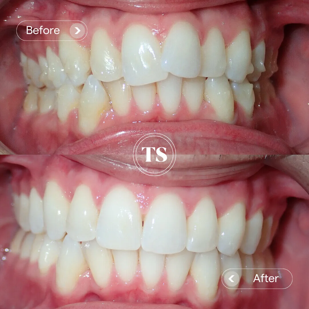 Barry’s Invisalign Makeover