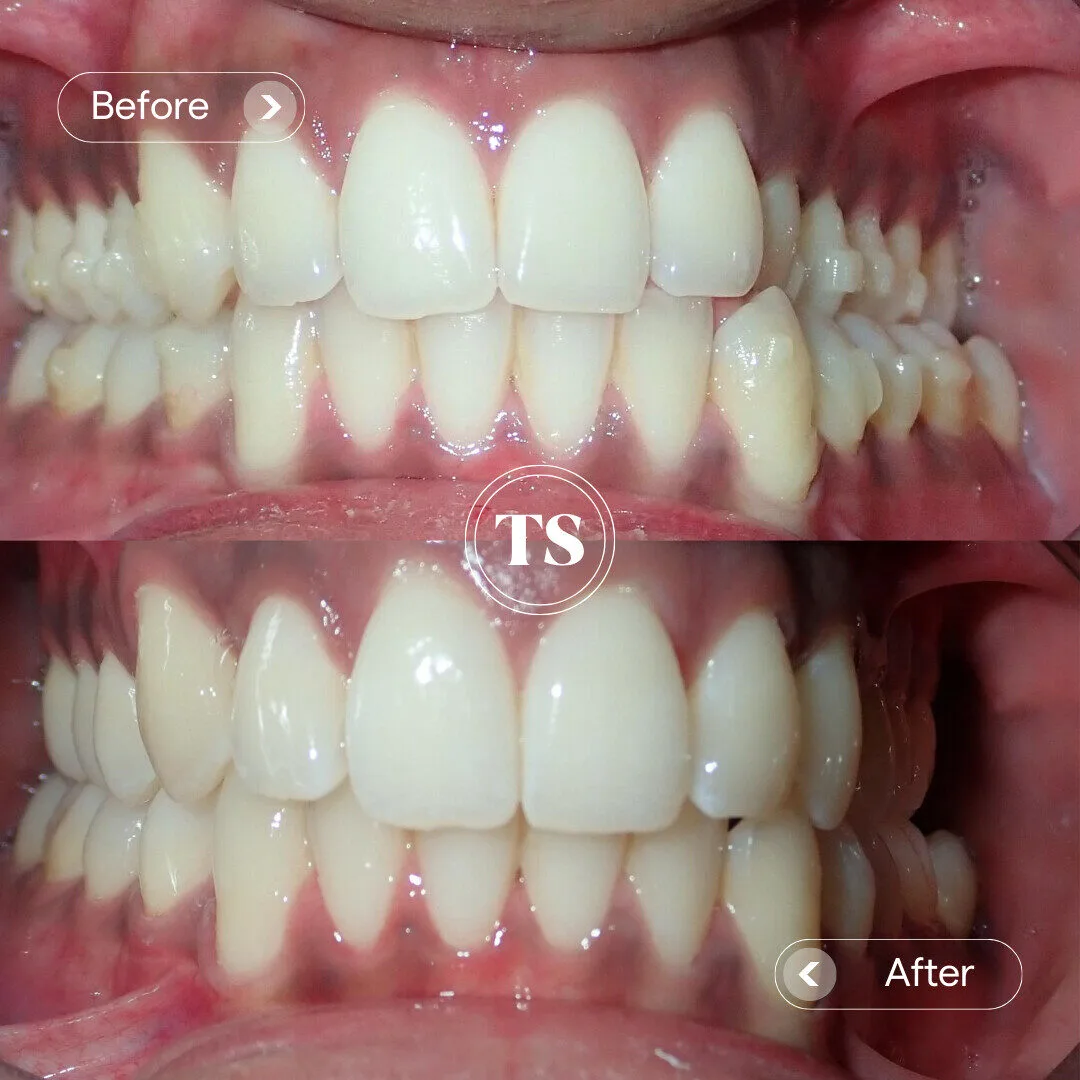 Cobber’s Invisalign Makeover