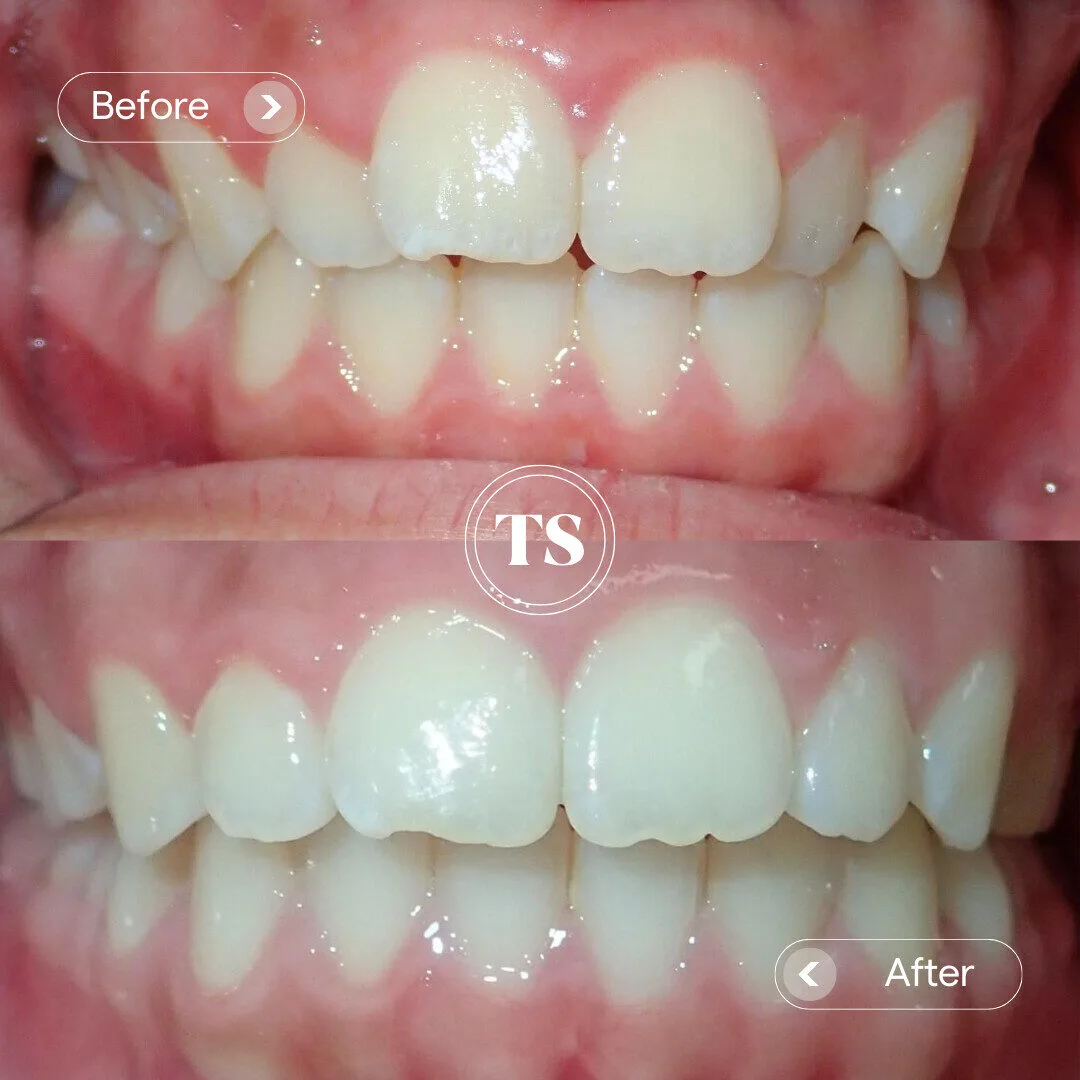 Daisy’s Invisalign Makeover