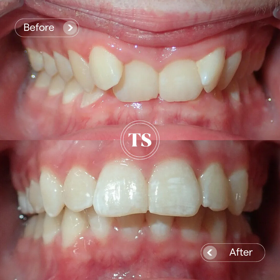 Darcy’s Invisalign Makeover