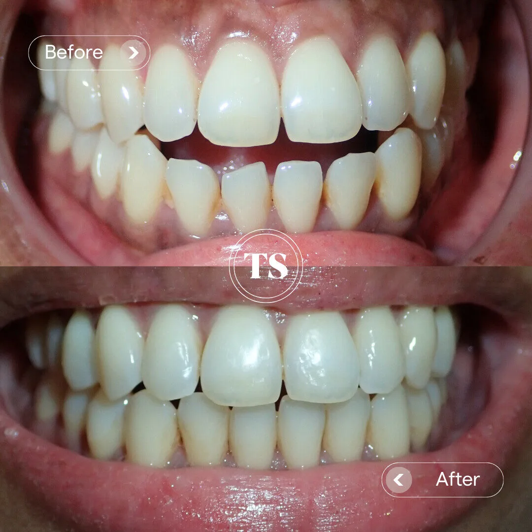 Ella’s Invisalign Makeover Ella Evans' Invisalign Makeover In Mount Annan after 9 months