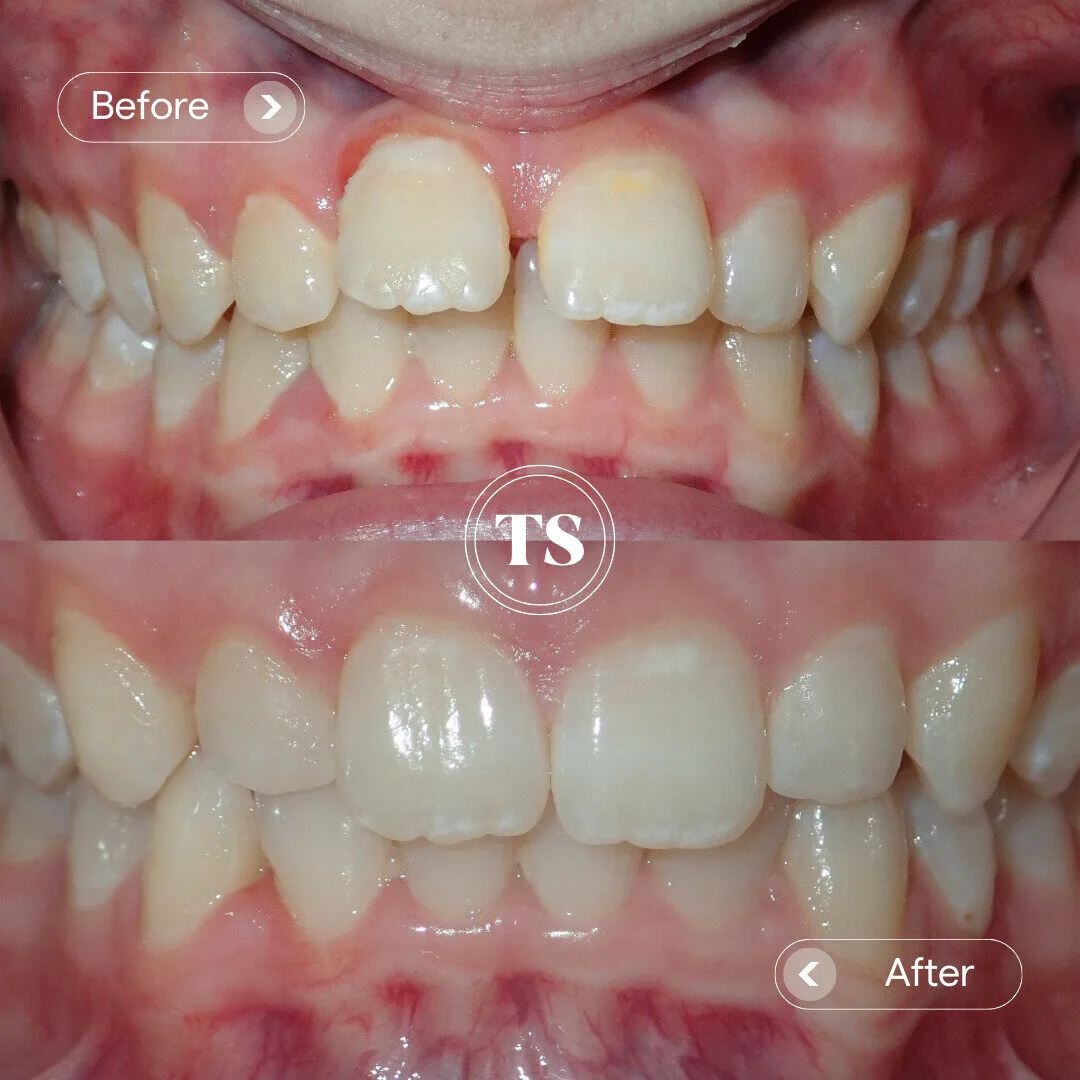 Freya’s Invisalign Makeover