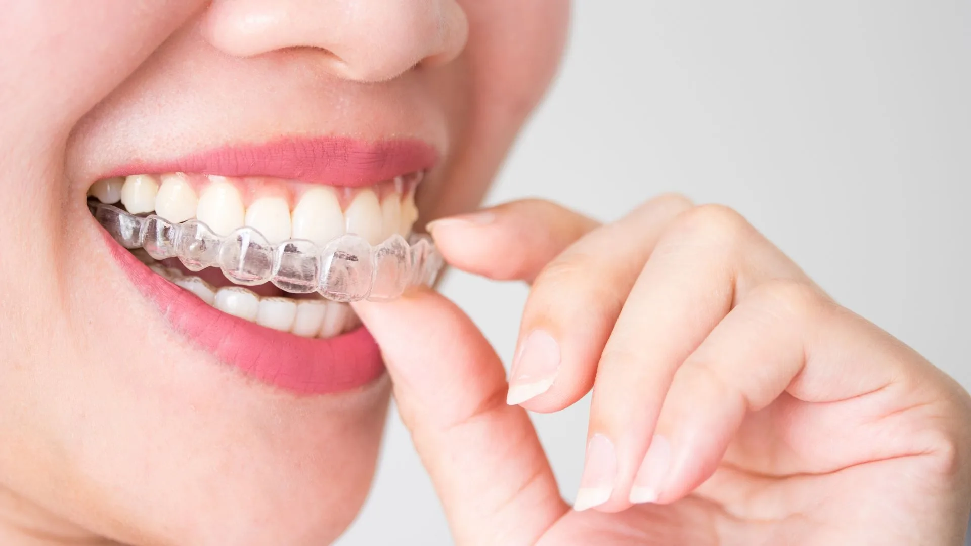 Invisalign, whitening, and gum contouring in Mount Annan in ToothSavers™