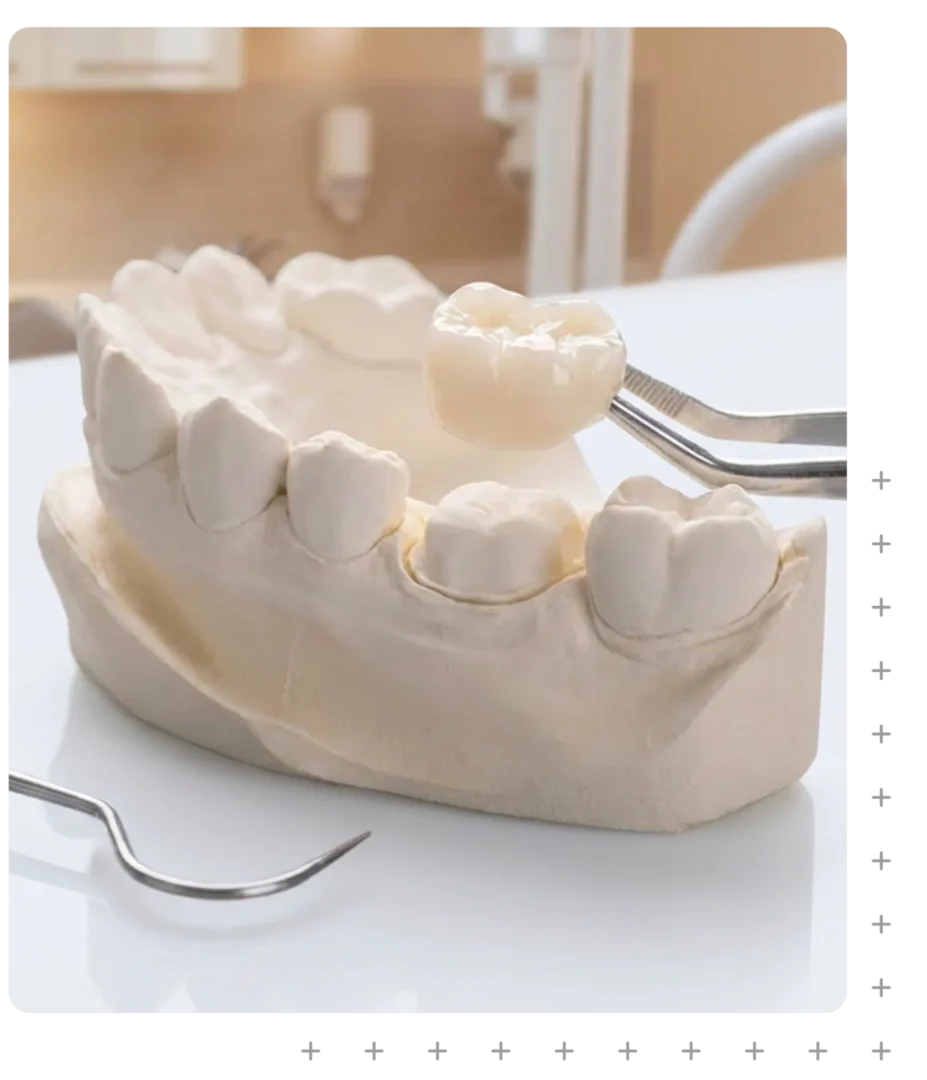 Custom Crown & Bridge at ToothSavers in Campbelltown, Narellan & Mount Annan