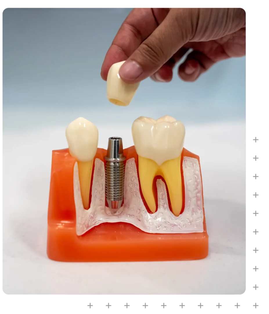 Dental Implants at ToothSavers in Campbelltown, Narellan & Mount Annan