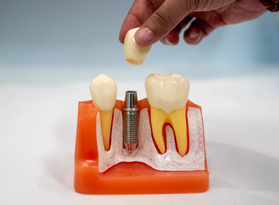 Dental Implants at ToothSavers in Campbelltown, Narellan & Mount Annan