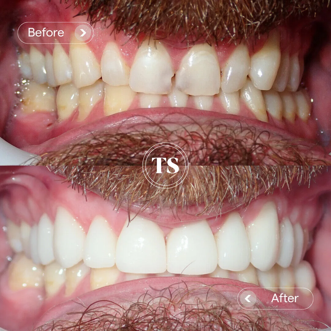 Archie’s Porcelain Veneers Makeover