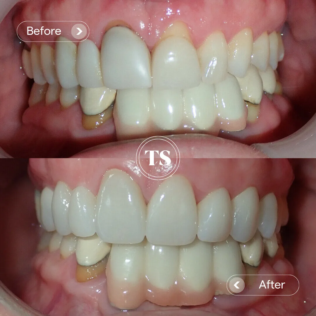 Ava’s Porcelain Veneers Makeover