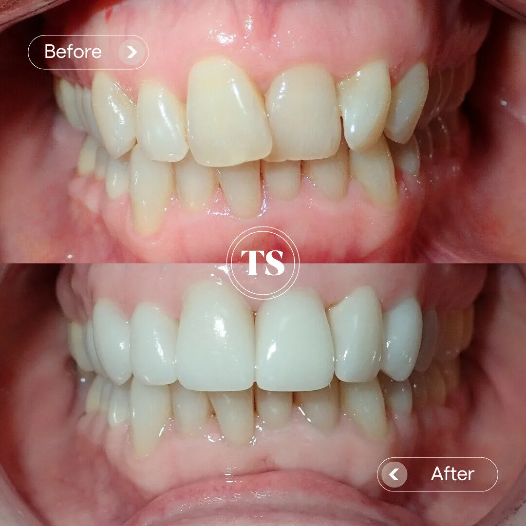 Billie’s Porcelain Veneers Makeover