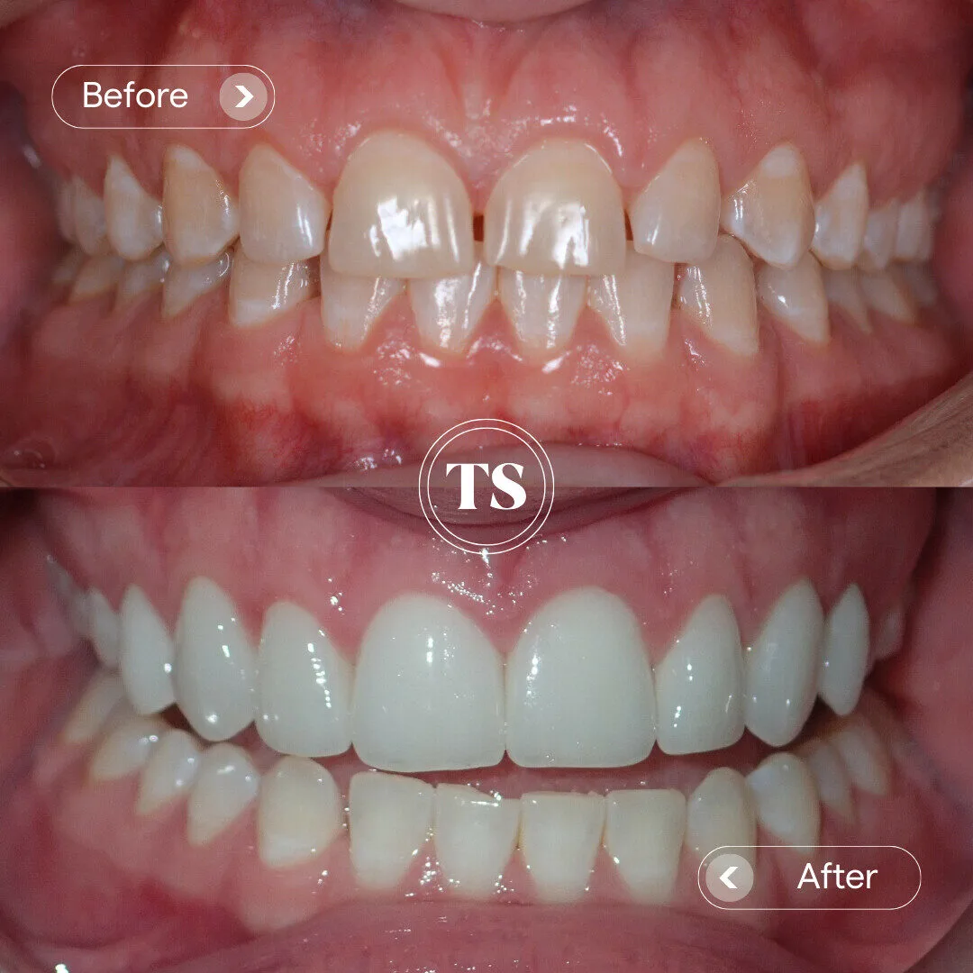 Chloe’s Porcelain Veneers Makeover