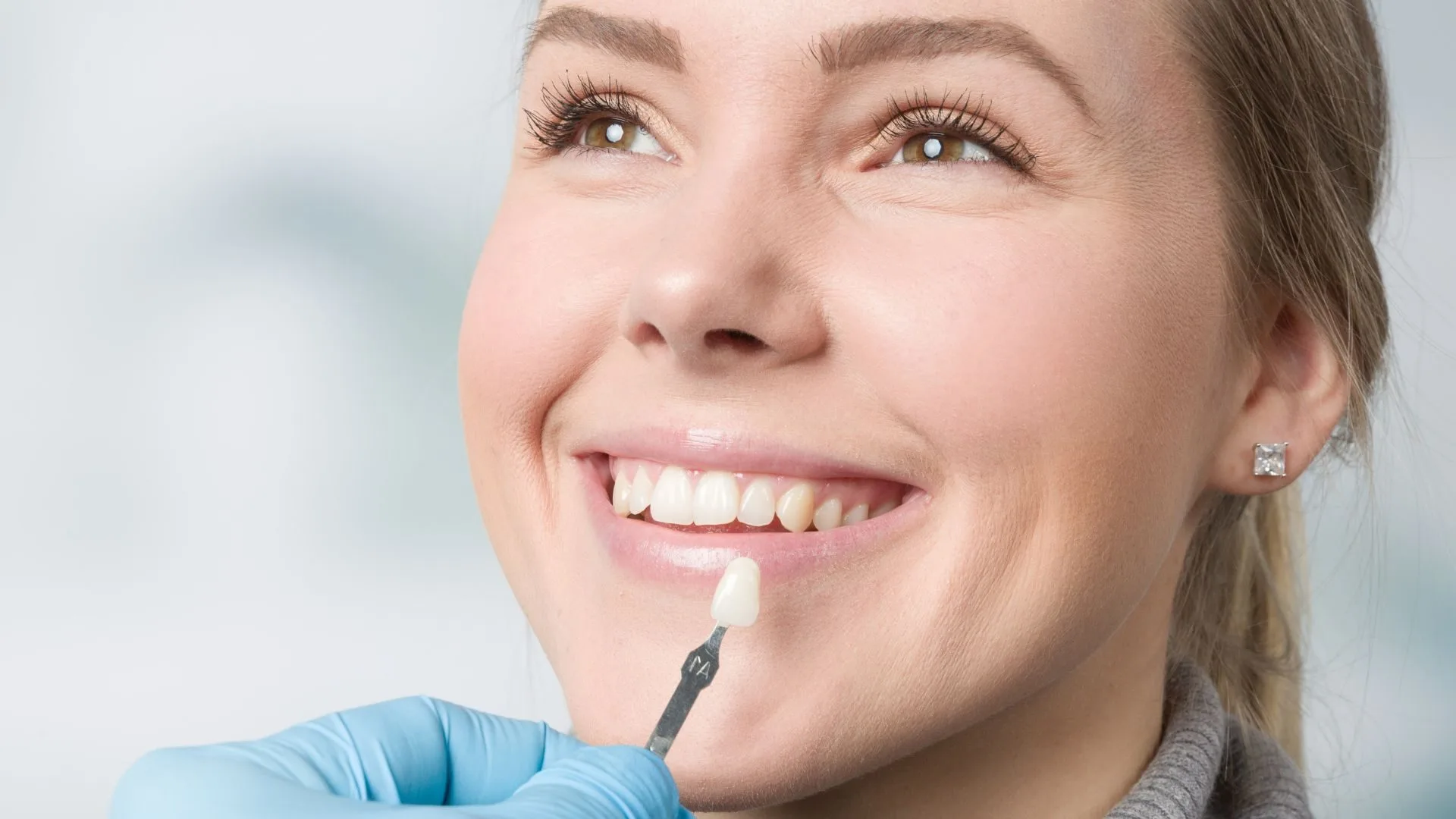 Porcelain Veneers and Teeth Whitening_in Mount Annan in ToothSavers™